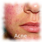 acne