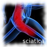 sciatica